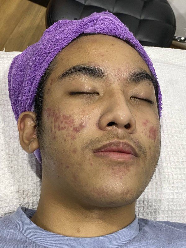 Comment gérer l'acné pendant une prise de masse ?